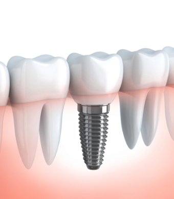 Dental Implants jawbone