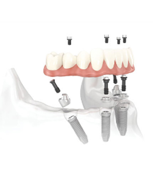 All-on-Four Dental Implant